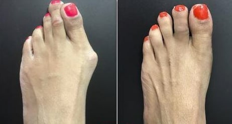 Orthopedic Toe Corrector For Hallux Valgus And Hammer Toes With Flexible Toe Spreader - Image 6