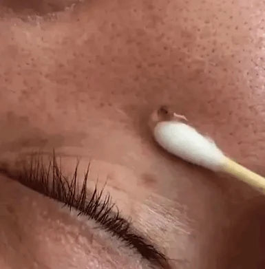 Blemish Cream For Painless Scar-Free Removal Of Moles Warts & Skin Tags - Image 5