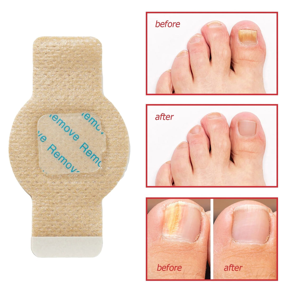 Nail Repair Patches With Antifungal Hydrogel Treatment For Toenails & Fingernails - Image 9