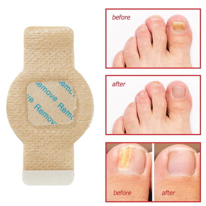 Nail Repair Patches With Antifungal Hydrogel Treatment For Toenails & Fingernails - Image 9