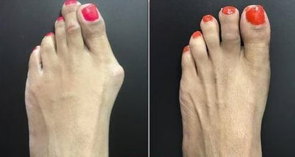 Orthopedic Toe Corrector For Hallux Valgus And Hammer Toes With Flexible Toe Spreader - Image 6
