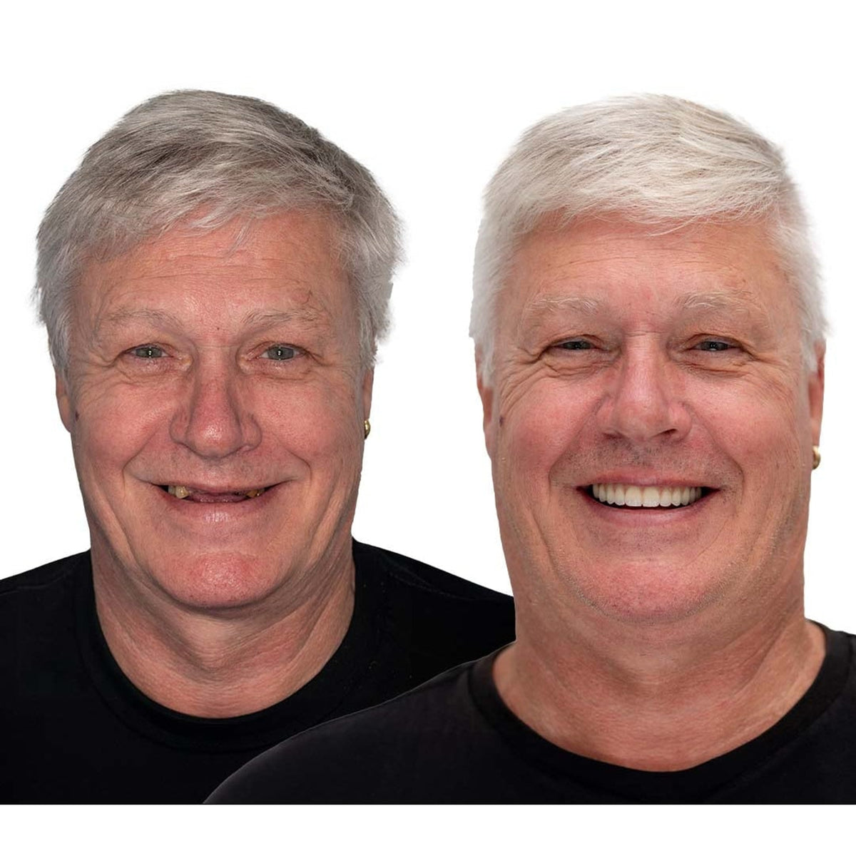 Removable Dentures With Flexible Cushion Grip Full Arch Set - Image 11