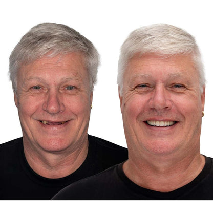 Removable Dentures With Flexible Cushion Grip Full Arch Set - Image 11